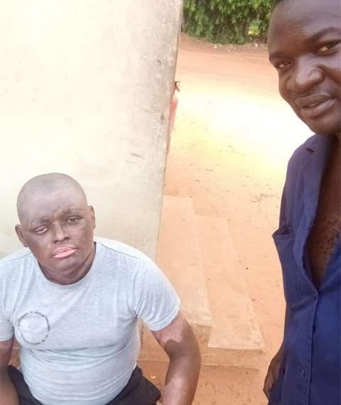 Togo : le militaire, brulé à l’huile chaude par sa femme, guérit (Photo)