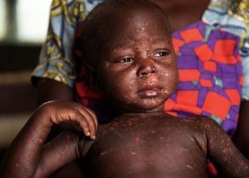 Togo : Des cas de rougeole confirmés dans plusieurs districts sanitaires