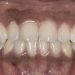 Halte à la dépigmentation des dents !